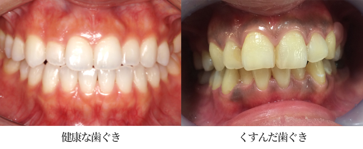 健康な歯ぐきと、くすんだ歯ぐき